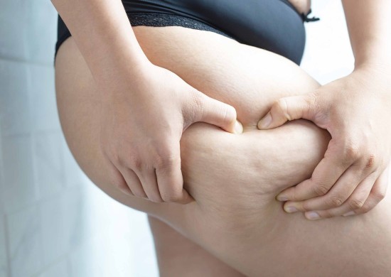 Lipodem (Ağrılı Selülit) Diyetisyeni Ankara